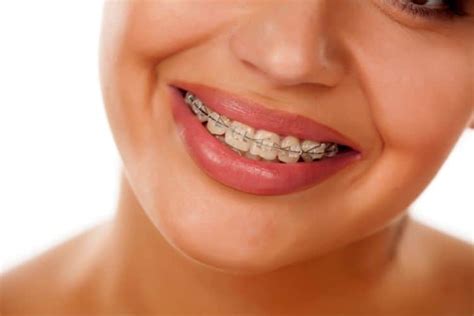 precio de brackets metalicos en mexico|cuanto cuesta un bracket.